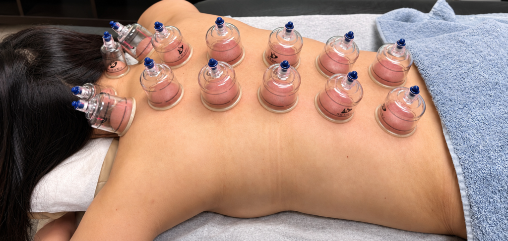 Stationary cupping with cups placed across a patient's back at Blissful Wellness